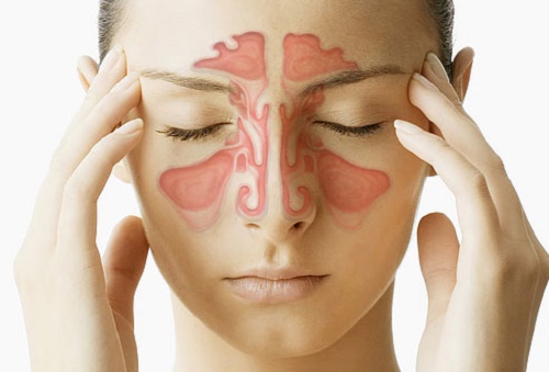 Sinusite: maîtriser les symptômes